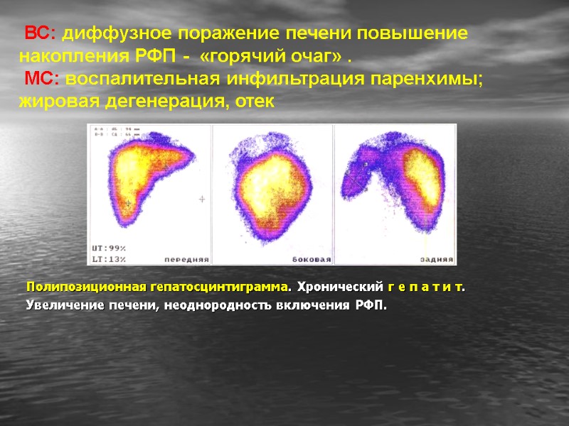 Полипозиционная гепатосцинтиграмма. Хронический г е п а т и т. Увеличение печени, неоднородность включения